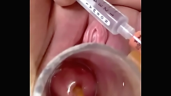 while catheter breaks through internal os and dilates it painfully with balloon