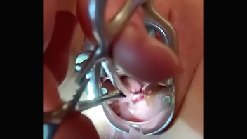 Sound tenaculum applying traction to cervix
