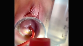 w 4cc inflation of catheter balloon inside cervix