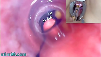 Mature Woman Peehole Endoscope Camera in Bladder with Balls